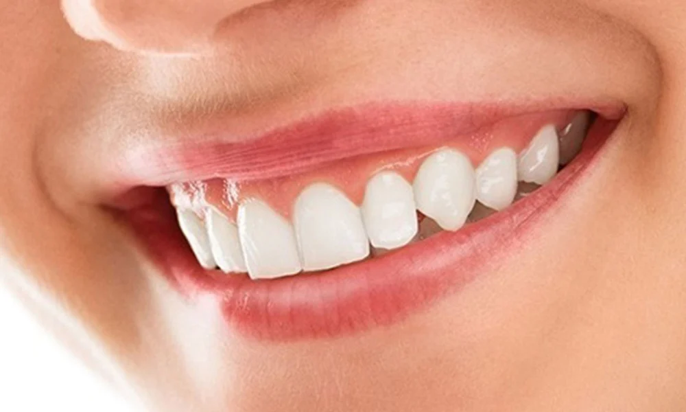 What Is a Smile Makeover? Treatments, Cost Factors, and Who Needs It